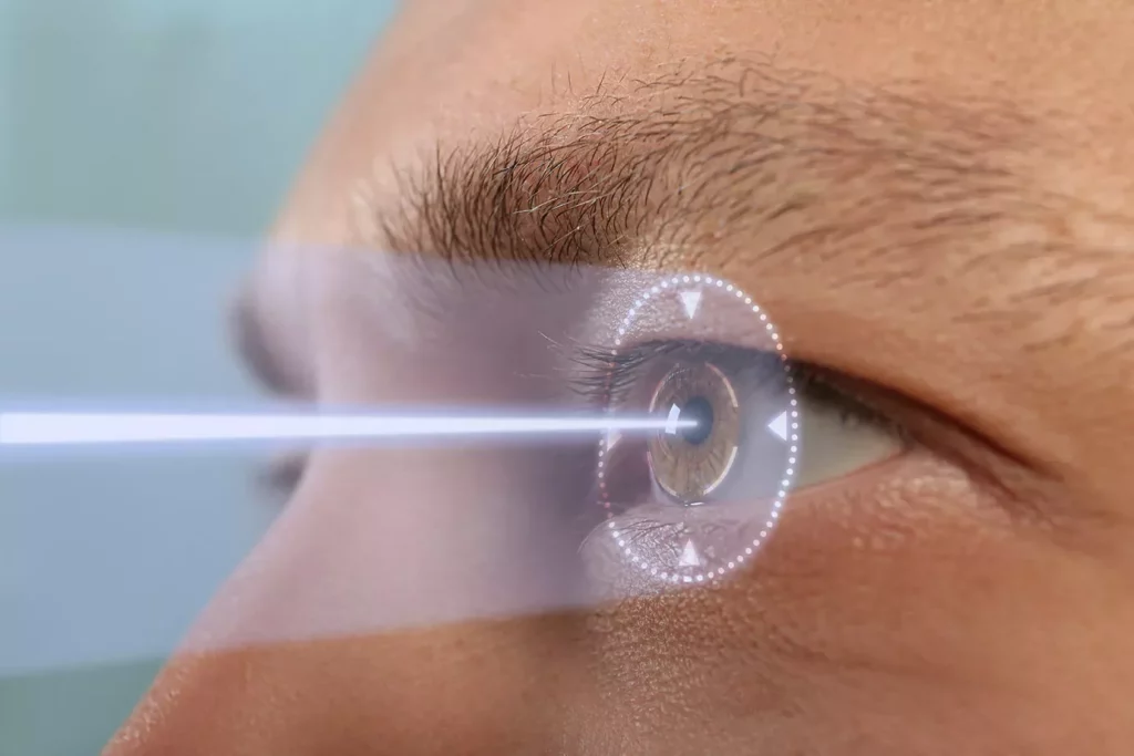lasik eye surgery